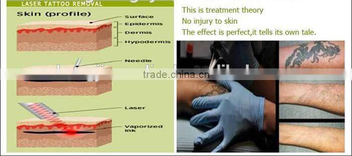 nd yag laser tattoo removal system machine