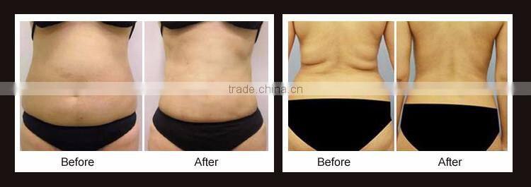 2016 Distributed wanted fat loss slimming device 13mm hifu cartridge