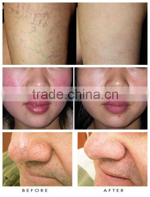 2016 newest Oem Service 980nm diode laser vascular removal machine price