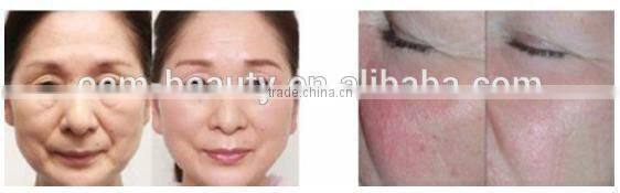 Table Facial Fractional rf skin tightening machine, radio frequency with cheaper price -F-TJ03