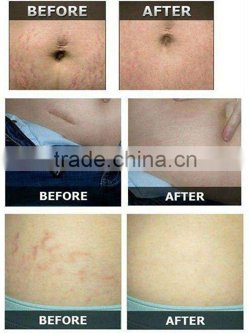 auto micro needle therapy system electric derma roller EL011 CE approval