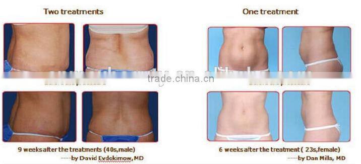 M-C201 2016 Updated slimming machine/portable fat freezing machine/fat freezing machine for home use