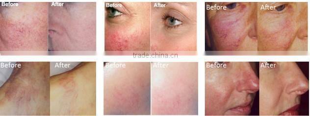 RBS02- Rayna 15W diode laser 980nm vascular removal machine