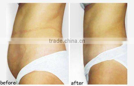New beauty machine bipolar RF/slimming/ Ultrasonic liposuction/ Bio facial machine