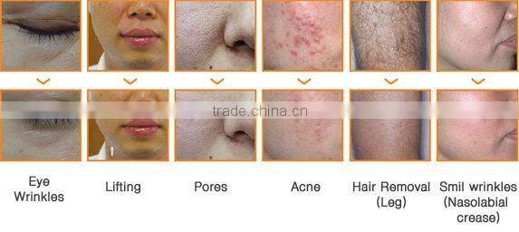 ipl laser hair remov multifunction ipl epilation
