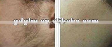 ipl machine photo skin rejuvenation