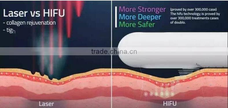 New technology hifu vaginal tightening machine 360 automatic roating