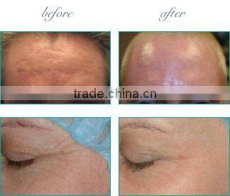 E-light(IPL&RF) beauty apparatus for Spa or Clinic