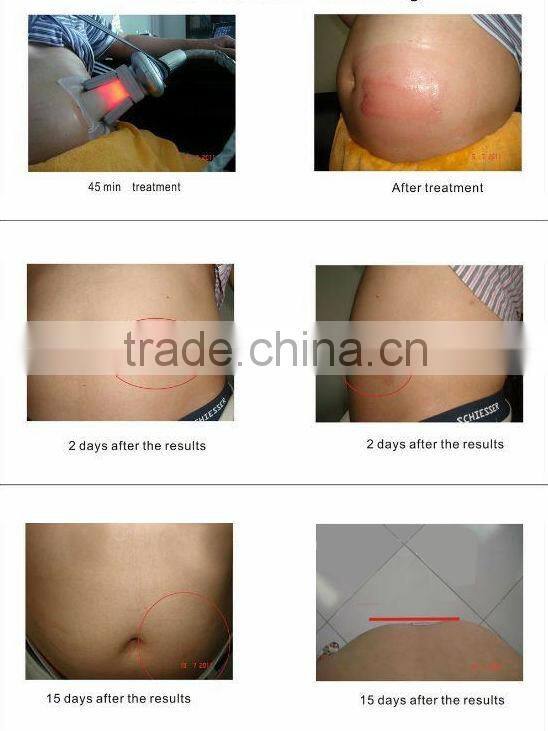 Chinese supplier wholesales 4 handles cryolipolysis machine