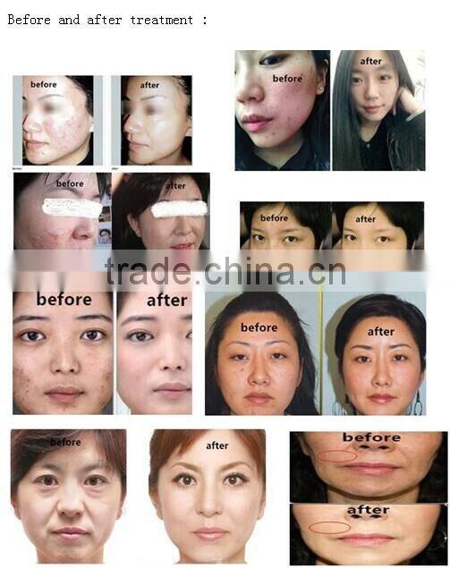 Very excellent portable wrinkle removal radio frequency rf machine for clinic beauty spa and so on