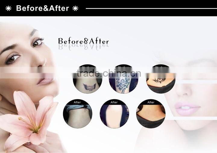 1064nm/532nm Laser tattoo removal machine/na yag laser dark skin tattoo removal