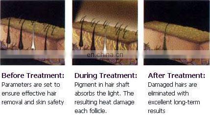 Effective Portable IPL E-light OPT Skin Rejuvenation Hair Removal Laser RF Wrinkle Removal Skin Tightening Machine