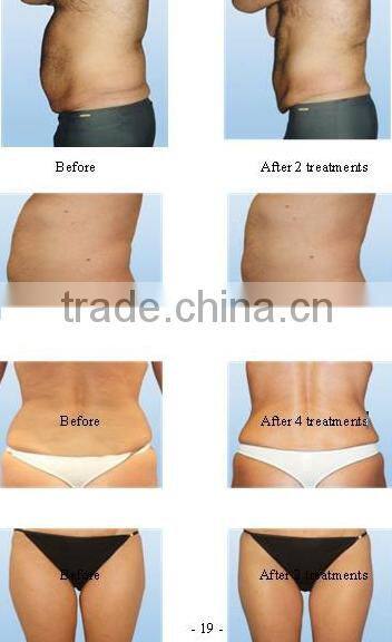 Effective fat reducer!!!! best vacuum rf portable cavitation slimming machine
