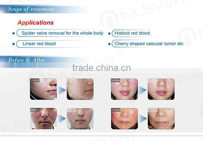 Pigmentation removal laser machine beauty salon equipment