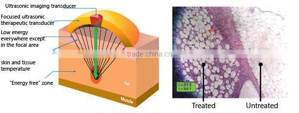 Chinese Unique Design High Intense Focus Ultrasound Hifu For Slimming
