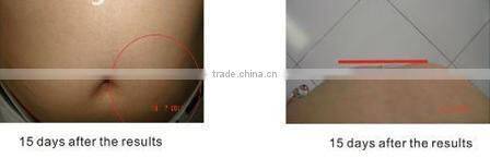 salon cryolipolysis bipolar tripolar rf vacuum cellulite ultrasonic