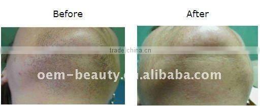 New Arrial Hot Sale Mini ipl hair removal equipment A005