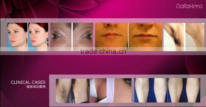 150000 shots, ipl hair removal machine, ipl laser epilator, ipl hair remover