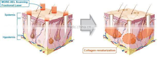 2016 Co2 Laser / Fractional Co2 Laser machinel Co2 Fractional Laser for acne treatment and wrinkle removal