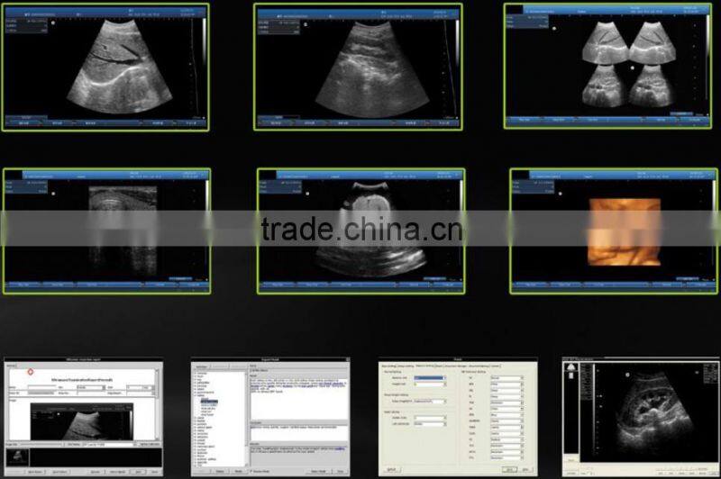 Hot Sale Full Digital Technology Ultrasound Scanner/ Echographe With Ce And Iso