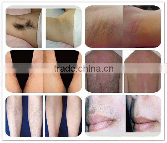 venus laser hair removal / china hair loss treatment / best laser hair removal machine