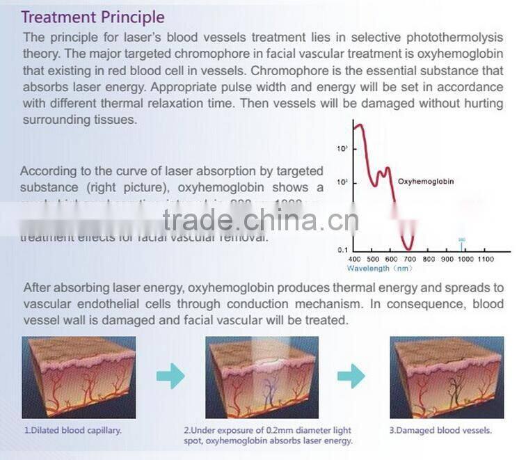 permanent remove vascular machine by 980nm diode laser