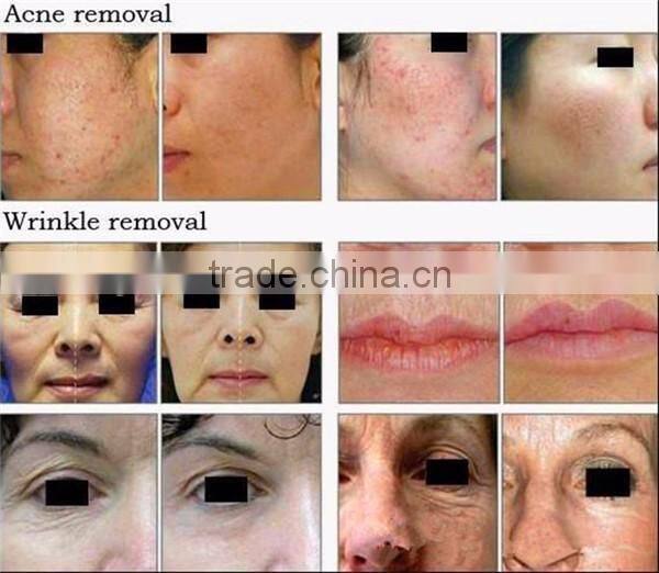 CE approved 2016 led pdt machine skin care for beauty salon/led light therapy machine