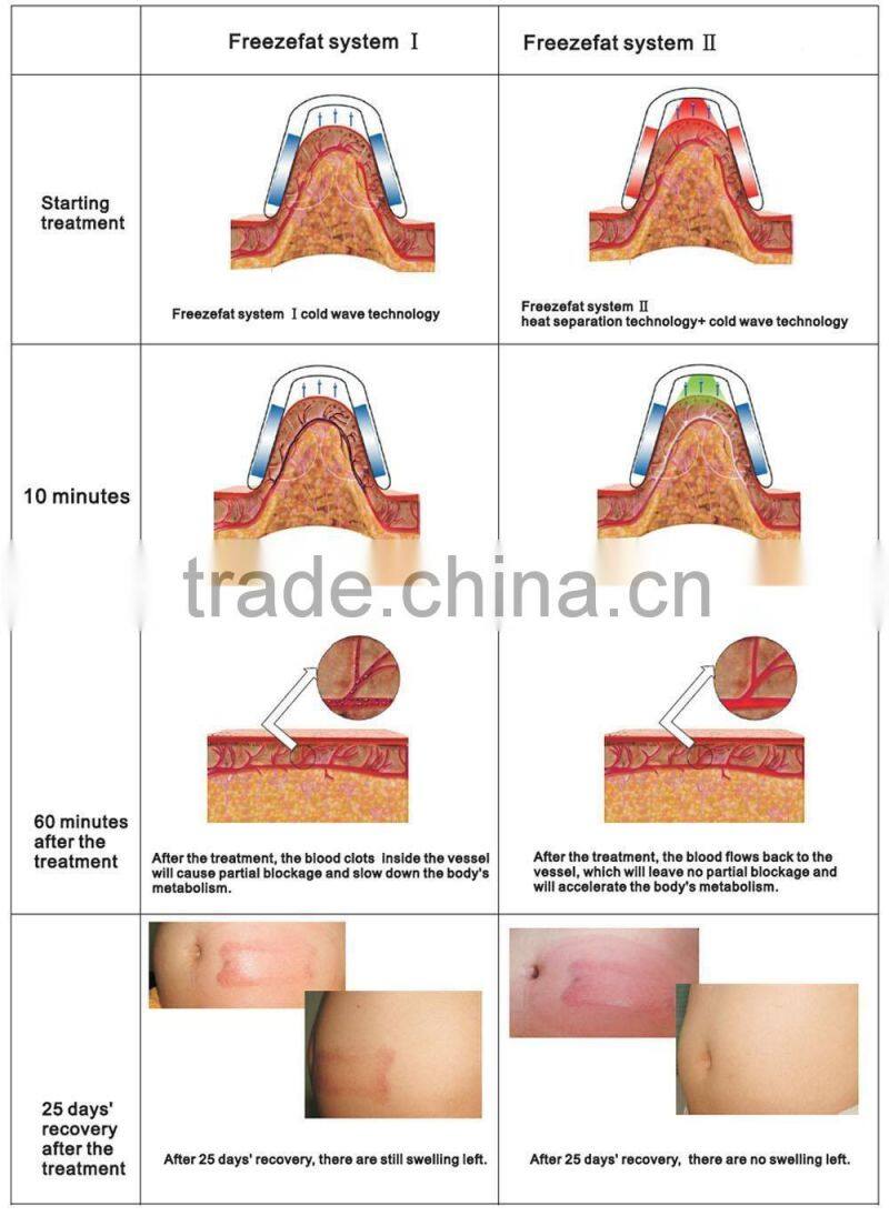 AYJ-835C ayplus fat freeze slimming machine