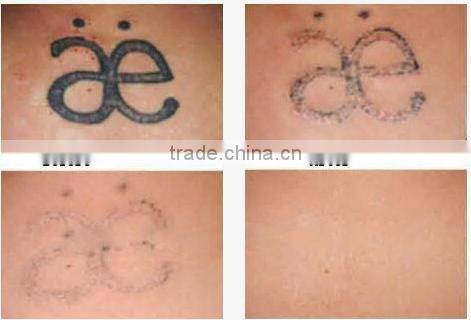wholesale laser tattoo removal machine nd-yag laser tattoo removal beauty machine