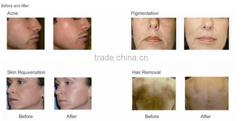 distributor wanted europe skin care equipment ipl