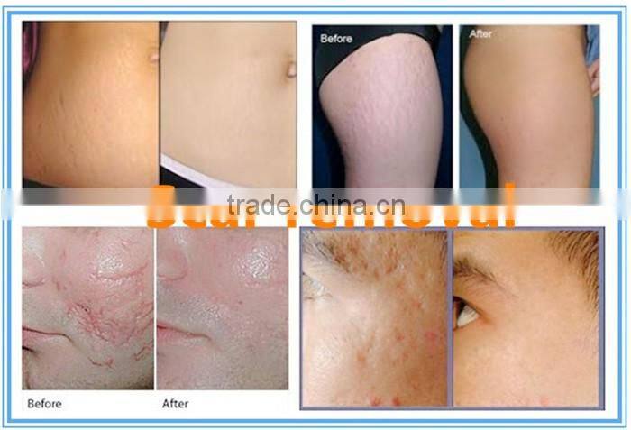 2940 erbium yag medical laser scar removal machine