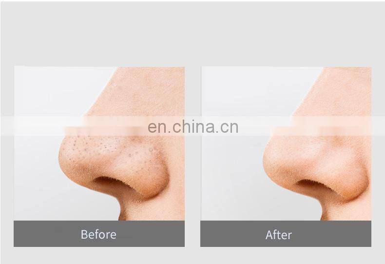 Popular Facial Beauty Blackhead Remover Tool Kit Stock Blackhead Removal with Advanced Vacuum Technology