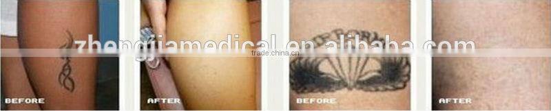 vertical q switch nd yag laser pigment and tattoo removal device