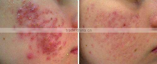 Beauty equipment tattoo removal machine multifunction Q Switched Nd Yag Laser device