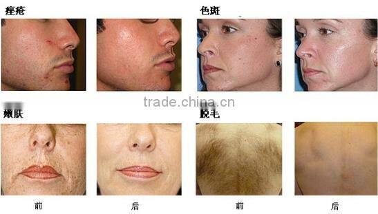2014 newest design multi-functional skin rejuvenation best ipl korea