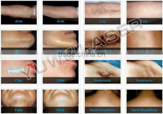 permanently and quickly speed 808 diode laser hair removal beauty machine