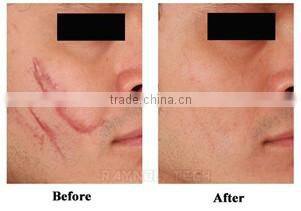 2016 Scar Removal 10600nm Laser Equipment CO2 Fractional