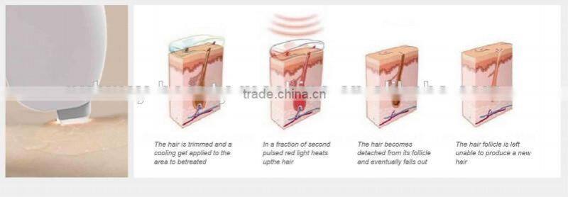 High performance epicare lamis hair removal diode laser