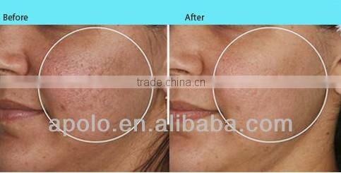 1540nm Er Glass Fractional Laser machine for wrinkle removal scar removal by Shanghai Apolo