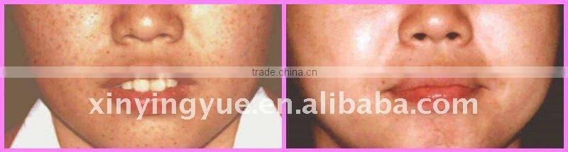 tattoo removal beauty equipment laser pigments removal