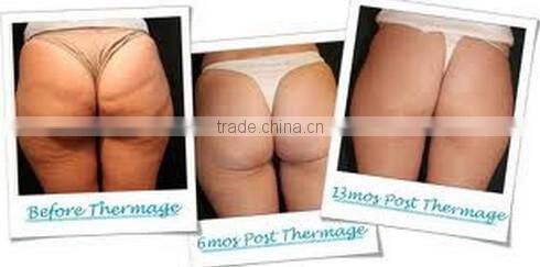 Hot Fractional & Micro needle RF machine for face lifting & skin rejuvenation