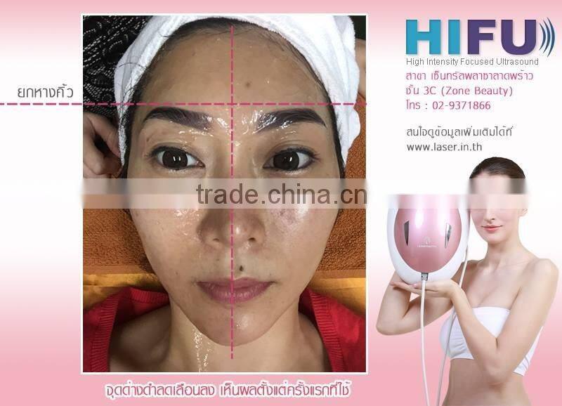2016 High-Intensity Focused Ultrasound/ Home hifu machine/hifu cartridge