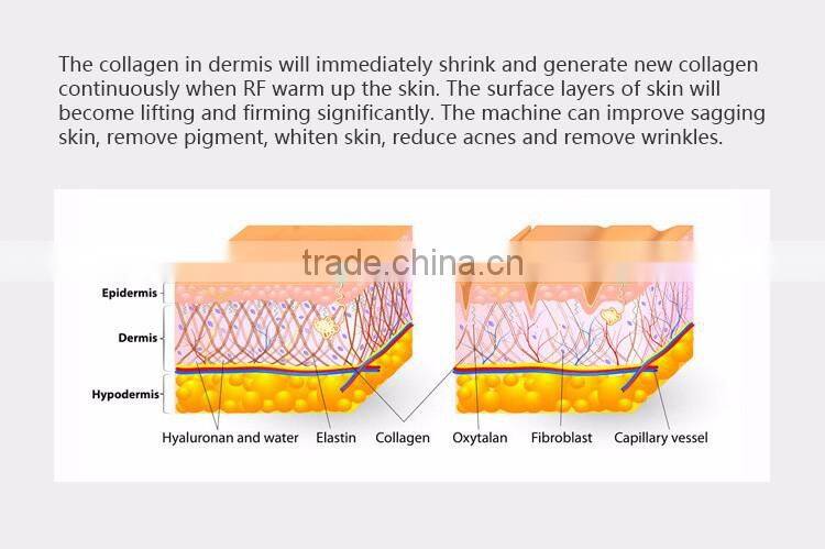 rf cavitation machine for smoother and tighter skin texture