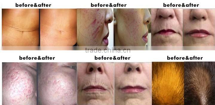 new type cosmetic use electric derma stamp micro needle treatment NL-EDP04