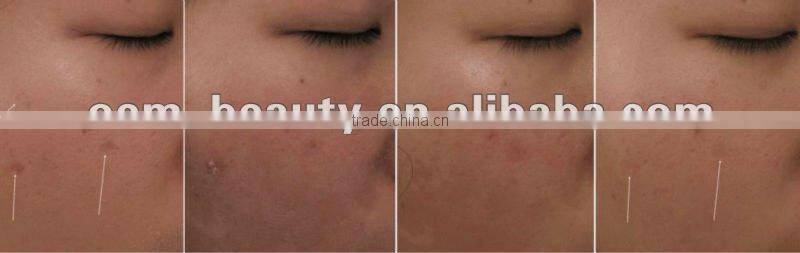 Skin micro-needling /Collagen Induction Therapy Derma Roller Manufacturer