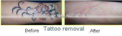 Tattoo Removal Laser Nd Yag Laser