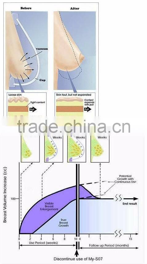 Portable super electric vacuum breast enlargement breast enhancer machine