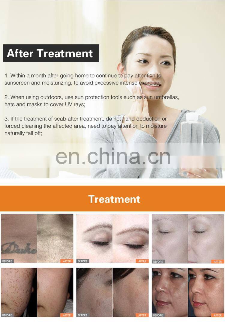 755nm honeycomb nozzle eyeline tattoo pigment removal pico laser machine