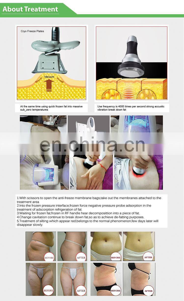 6 in 1 cavitation machine body anticellulite machine slimming cryo 21 machine cellulite reduction factory price
