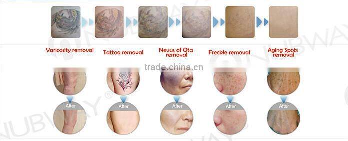 professional laser tattoo removal device/tattoo removal /tattoo removal equipment